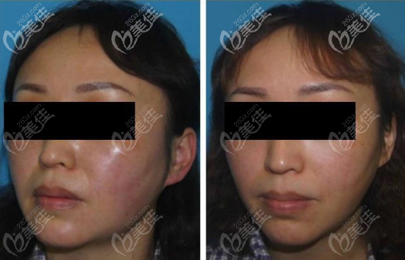 泰國拉低喃醫(yī)院黃金微雕面部吸脂照片 泰國拉低喃醫(yī)院黃金微雕面部吸脂照片