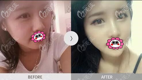 面部綜合整形真人對比案例照 面部綜合整形真人對比案例照