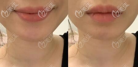 親歷者下巴截骨前移手術(shù)前后效果對比圖 親歷者下巴截骨前移手術(shù)前后效果對比圖