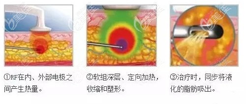 黃金微雕溶脂過程 黃金微雕溶脂過程