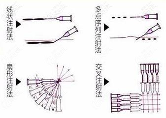鄭錦洪醫(yī)生擅長的玻尿酸打法 鄭錦洪醫(yī)生擅長的玻尿酸打法
