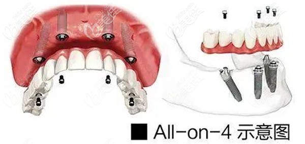 ALL- on-4種植牙技術 ALL- on-4種植牙技術