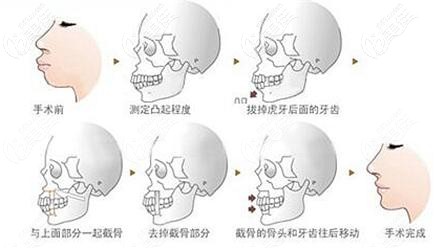正頜手術(shù)過程示意圖