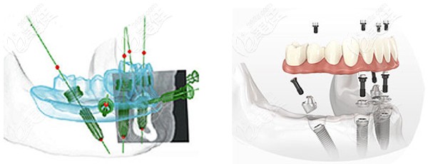 all-on-4種植牙技術(shù)優(yōu)勢 all-on-4種植牙技術(shù)優(yōu)勢