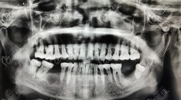 父親滿口牙松動(dòng)牙片 父親滿口牙松動(dòng)牙片