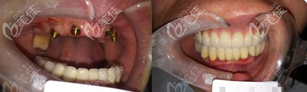 60歲父親滿口牙松動做all-on-4全口種植牙后表示：后悔知道晚了