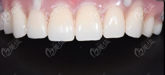 叔叔表示:上半口牙全部缺失,植入6顆植體后終于能啃排骨了