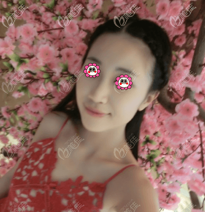 我做光纖吸脂雙下巴沒(méi)有硬塊的情況出現(xiàn)喲 我做光纖吸脂雙下巴沒(méi)有硬塊的情況出現(xiàn)喲