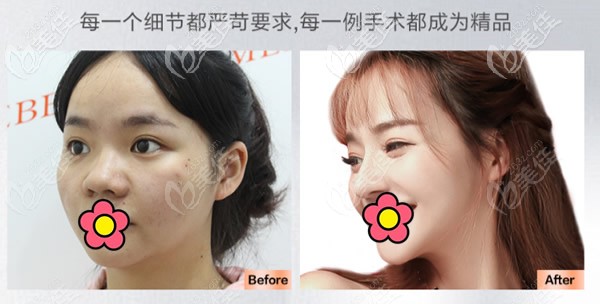 王旭明醫(yī)生全肋骨隆鼻案例