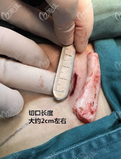 取肋傷口小不留疤