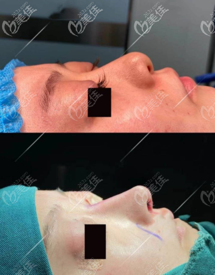 重慶軍科半肋軟骨隆鼻案例效果圖