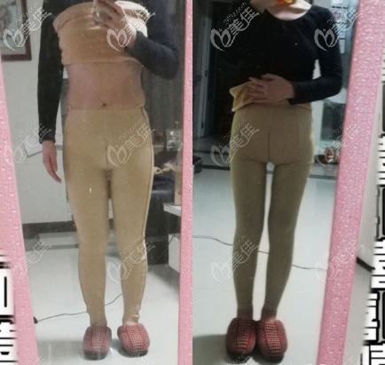 Suthipong Treeratana醫(yī)生大腿環(huán)吸<span style=