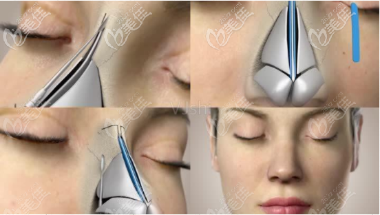 張浩短期內(nèi)可開展鼻修復(fù)手術(shù)