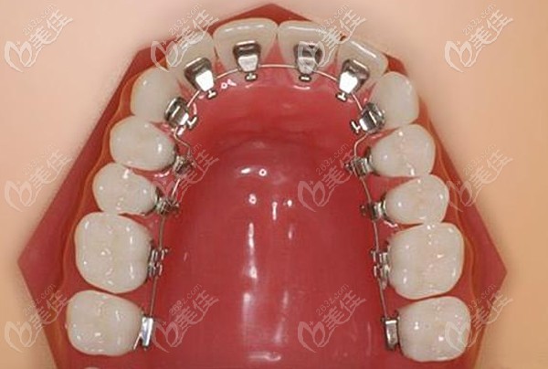 舌側(cè)隱形矯正的優(yōu)勢 舌側(cè)隱形矯正的優(yōu)勢