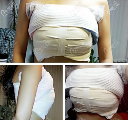 假體隆胸后包扎圖片