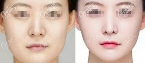 下頜角削骨截骨術前術后對比照 下頜角削骨截骨術前術后對比照