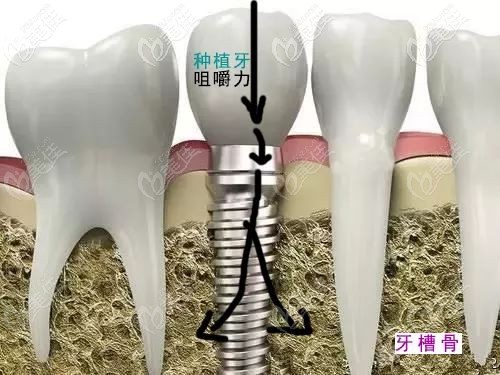 種植牙的受力情況
