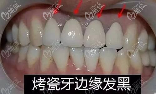 烤瓷牙黑線問題