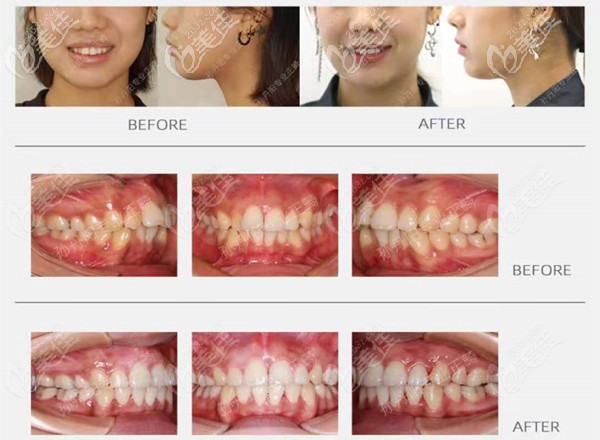 孫丹陽醫(yī)生矯正效果