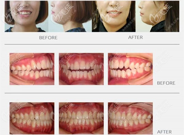 孫院長(zhǎng)牙齒開頜案例