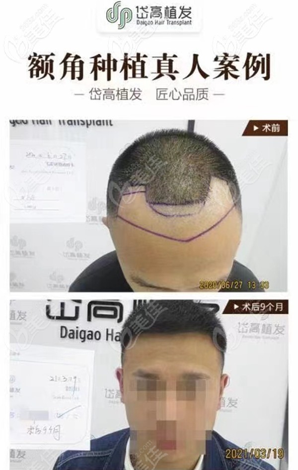 長沙岱高額角種植案例