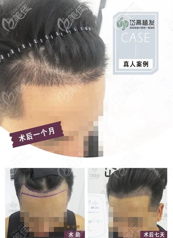 岱高前額發(fā)際線種植案例