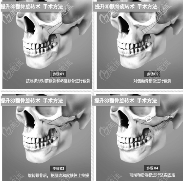 3D顴骨旋轉(zhuǎn)術(shù)的手術(shù)圖解