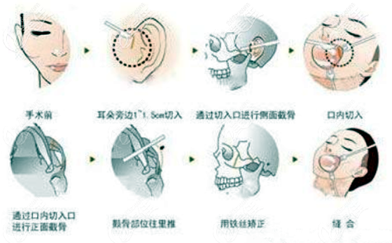 顴骨內(nèi)推的手術(shù)圖解