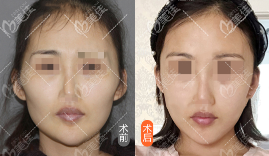 3d顴骨旋轉(zhuǎn)截骨手術(shù)效果圖