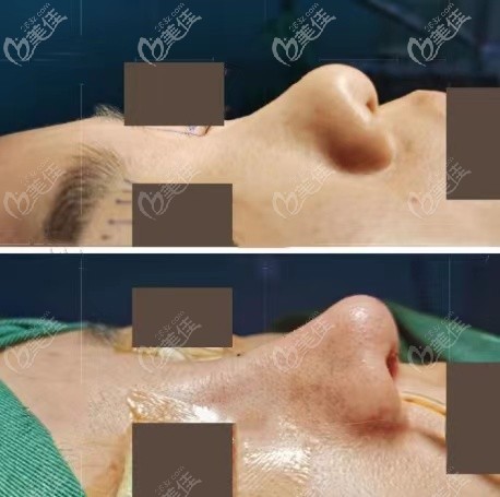 張國強(qiáng)半肋綜合隆鼻效果圖