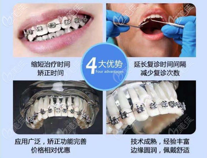 金屬矯正器的4大優(yōu)勢