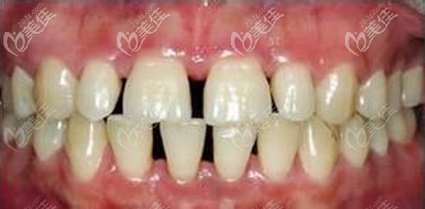 牙縫大的我不敢張嘴 牙縫大的我不敢張嘴