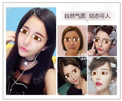 低鼻梁修復(fù)案例