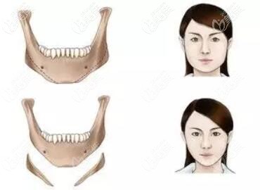 下頜角削骨前后效果 下頜角削骨前后效果