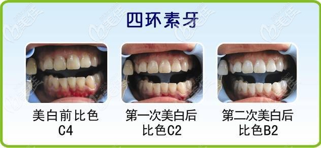 四環(huán)素牙美白前后對(duì)比圖