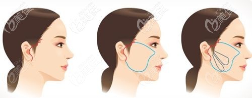 面部除皺拉皮原理