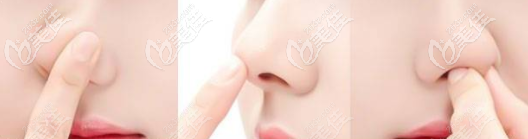 廣州壹加壹李石峰做鼻子的優(yōu)勢 廣州壹加壹李石峰做鼻子的優(yōu)勢