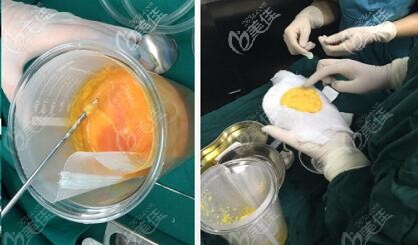 5G維密脂雕吸出的脂肪