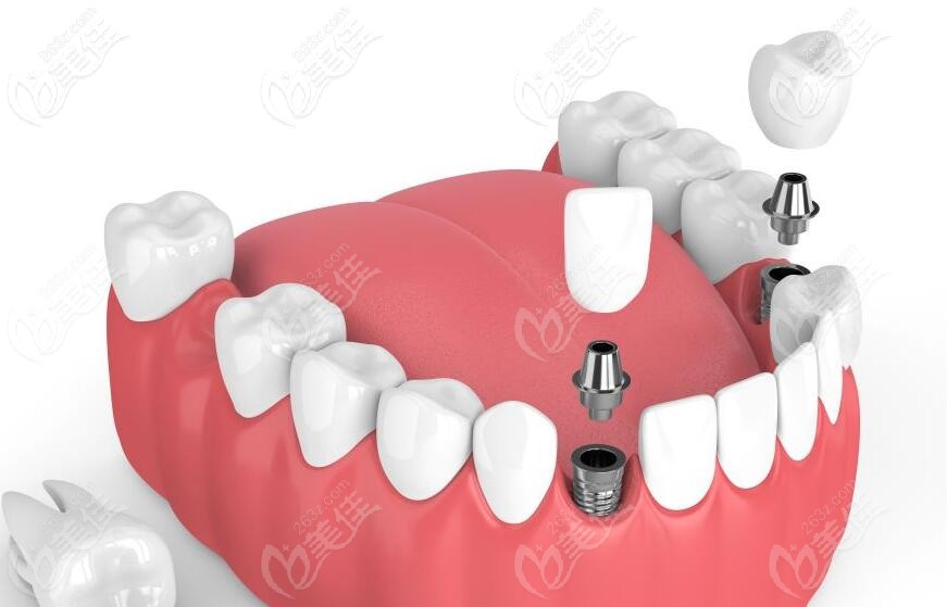 即刻種植適用條件