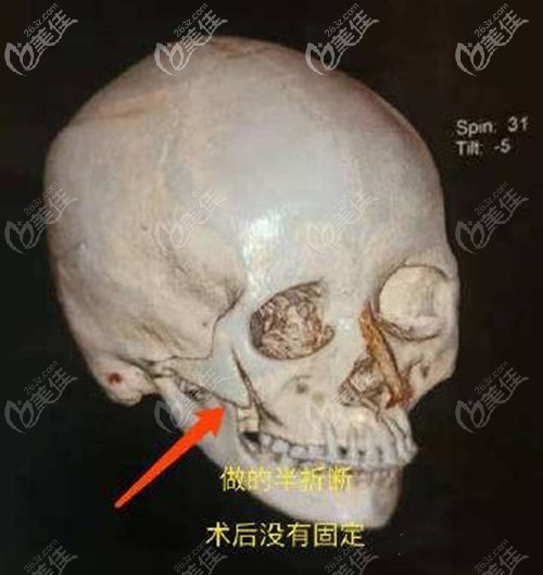 顴骨半折斷不固定的原理