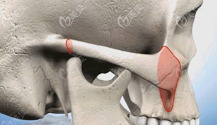 顴骨雙向折斷原理