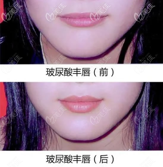玻尿酸豐唇前后對(duì)比照片