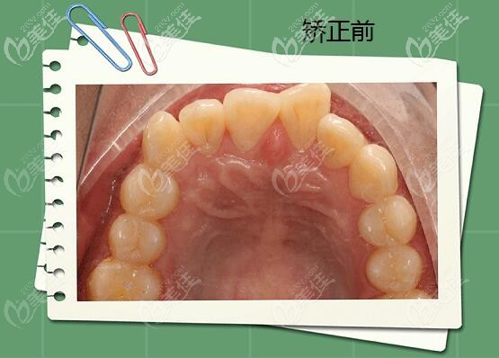北京精德口腔牙齒擁擠矯正案例 北京精德口腔牙齒擁擠矯正案例