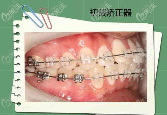 牙齒中度擁擠+前突初戴牙套 牙齒中度擁擠+前突初戴牙套