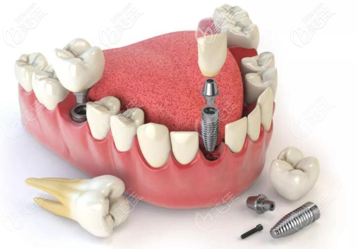 種植牙的結(jié)構(gòu)分布