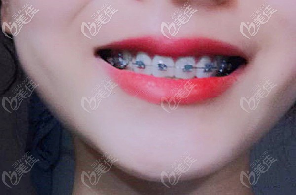 自鎖托槽矯正地包天