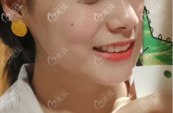 爆照！戴國(guó)產(chǎn)自鎖托槽正畸牙套矯正假性地包天小姐姐的漂亮反擊