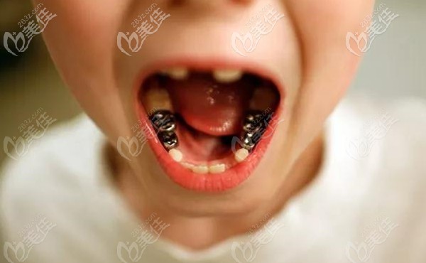 戴預成冠的兒童口內照