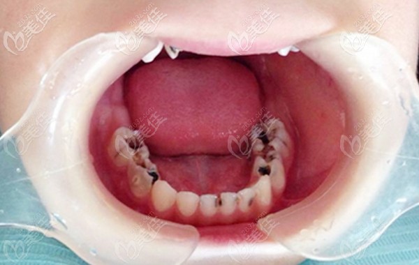 小孩子齲壞的乳牙