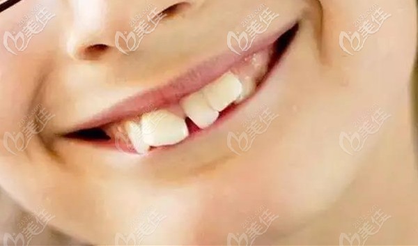 小孩早期牙齒畸形癥狀圖